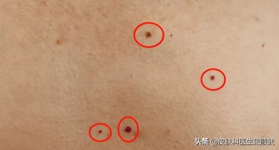 ​胸前长了几个“红痣”，是不是肝脏不行了？