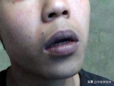 ​嘴唇颜色暗怎么调理中医 嘴唇发暗吃什么药好