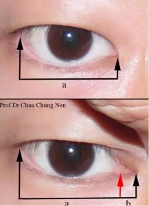 ​做双眼皮为何要同时开眼角？眼部整形医生说出答案，让人恍然大悟